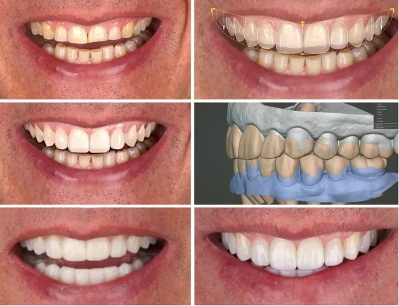 Caso de estética dental antes y después